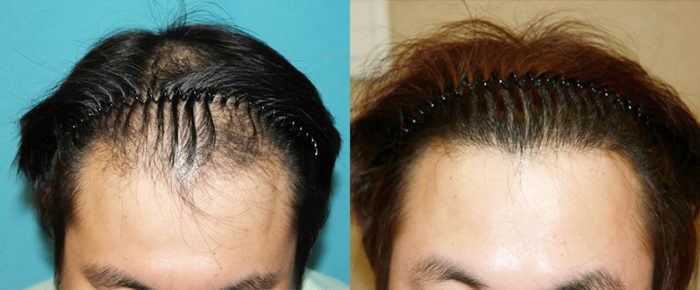 韓国植毛グローバルヘアー