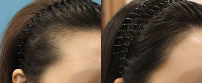 韓国植毛した事例女性グローバルヘアー