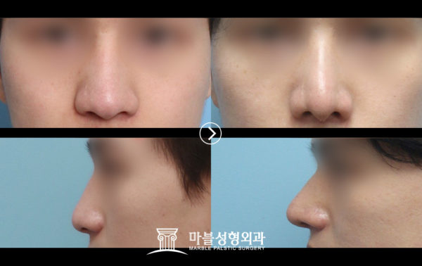 韓国鼻の整形