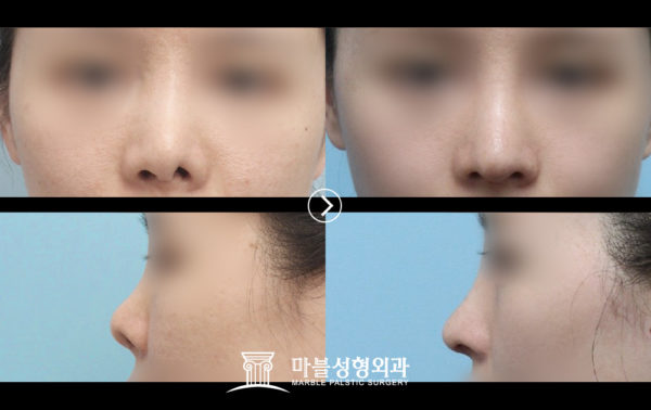韓国鼻の整形